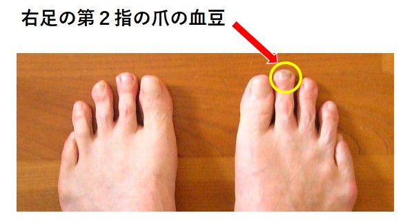 右足の第２指の爪の血豆の画像イメージ