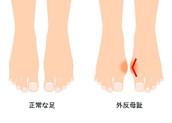正常な足と外反母趾の画像イメージ
